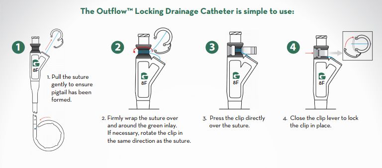 Outflow locking catheter instructions: image from Galt